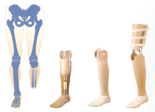 Prosthesis Leg Types Types of Prosthetic Leg – Prosthetics Blog