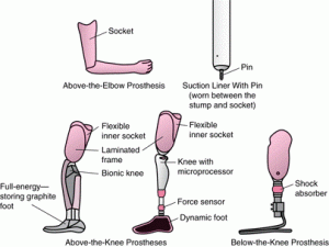 Types of Prosthetic Leg