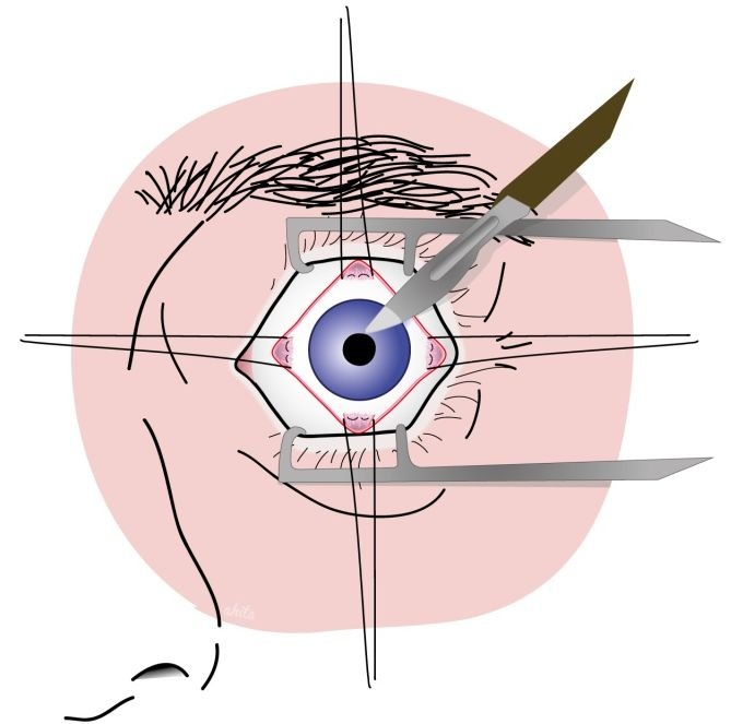Evisceration